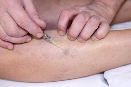 Escleroterapia_aplicacao_campinas_sp